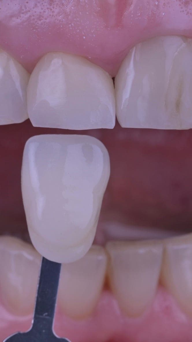 Teeth Whitening